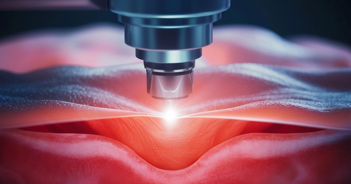 บริการและแพ็กเกจผ่าตัดริดสีดวงด้วยเลเซอร์